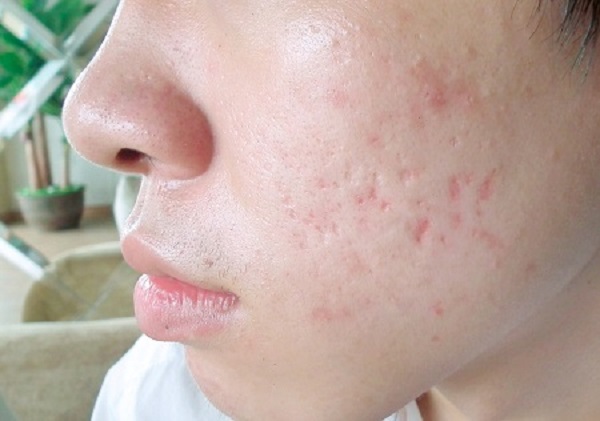 Công thức xóa sẹo lõm với hỗn hợp bơ cacao